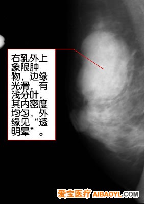 認識乳腺鉬靶照片 - 馬夫 - 馬夫的博客