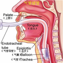 氣管插管術(shù)