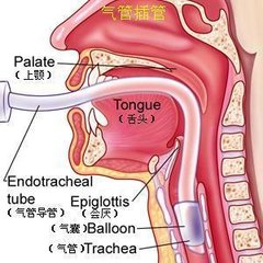 氣管插管22