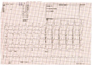 心衰并 LBBB 患者行希浦系統(tǒng)起搏 CRT-D 植入