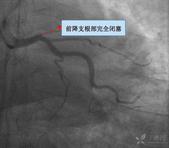 血栓抽吸術(shù)：如何有效防治致栓塞風險？