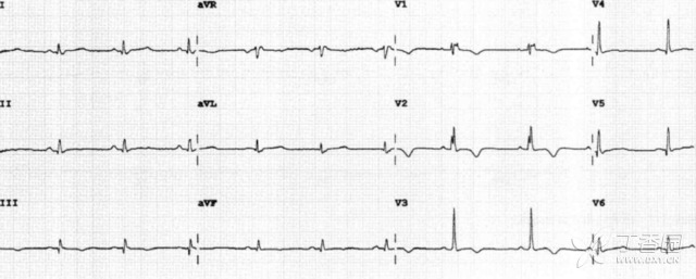 罕見危重癥心電圖：這 8 種波形你能識(shí)別幾種？