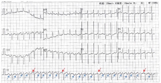 手把手解讀心電圖：被誤診的「房顫」患者