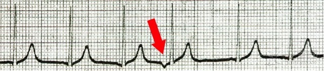 早搏與逸搏：聊聊這對(duì)「背道而馳的孿生兄弟」