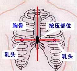 精狠準(zhǔn)急救八訣：基礎(chǔ)心肺復(fù)蘇與自動體外除顫器用法