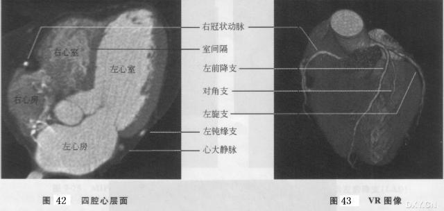 10 分鐘學會心血管 CT 解剖