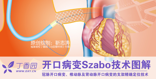 圖解冠脈介入：開口病變 Szabo 技術(shù)詳解