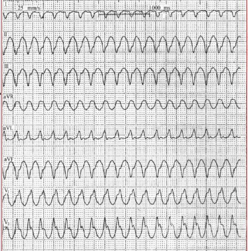 心電圖寬 QRS 波三步鑒別法（綠色精簡版）