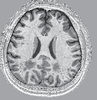 缺血性腦損傷的血液透析者：透析中血壓高好還是低好,？