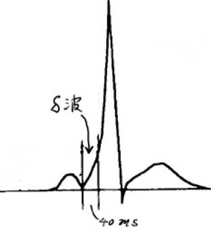 原配與小三之爭(zhēng) ：預(yù)激綜合征的故事