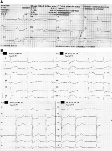 反常栓塞同時(shí)引起 STEMI 和肺動(dòng)脈栓塞一例