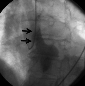 病例報道：以 STEMI 為表現(xiàn)的主動脈夾層一例