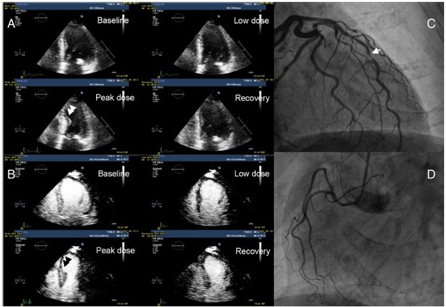 臨床綜述：面面俱道藥物負(fù)荷超聲心動(dòng)圖