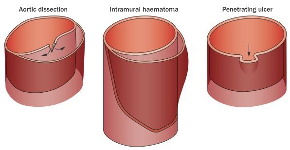 臨床綜述：急性主動脈綜合征管理