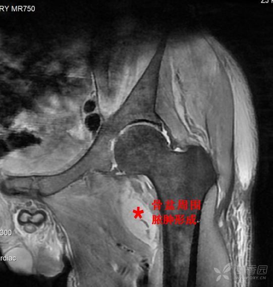 發(fā)熱、大腿酸痛,、活動(dòng)受限,，兇手是誰(shuí)？