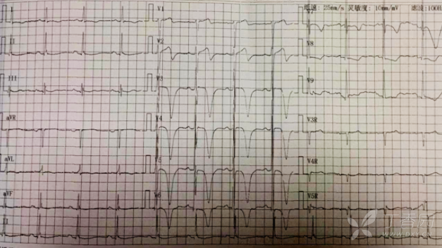 T 波出現(xiàn)巨大倒置,，高手是這樣分析的