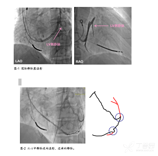 安貞醫(yī)院：應(yīng)用冠脈逆向技術(shù)完成 1 例高難度 CRT-D 手術(shù)