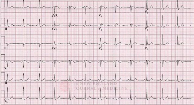 NEJM 丨 ICD 植入又取出還放了支架,，她的坎坷經(jīng)歷究竟為哪般,？