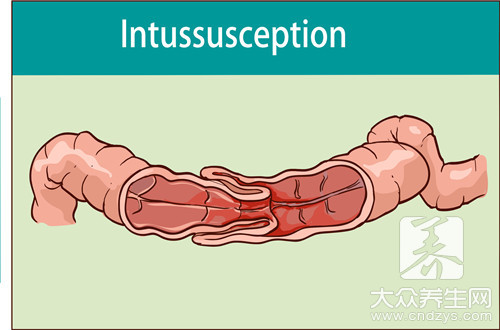小孩套腸是什么引起的