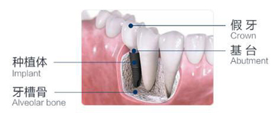 廊坊做種植牙為什么比活動(dòng)假牙更好?