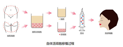 自體脂肪移植